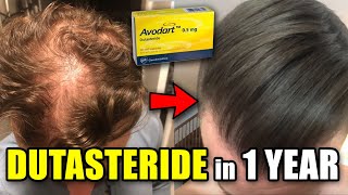 CRAZY Dutasteride Hair Loss REVERSAL In Only 1 Year [upl. by Fritts]